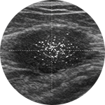 미세석회화 위치 확인