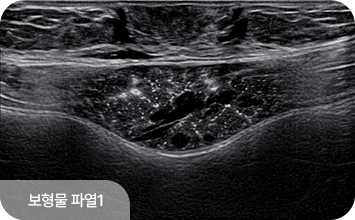 보형물 파열1