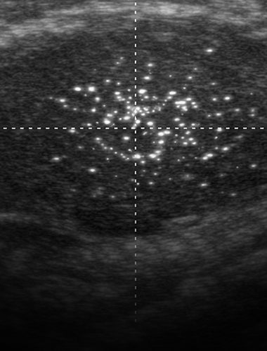 미세석회클리닉